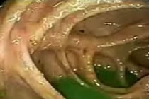 Magenparasiten